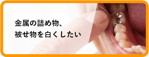 金属の詰め物、被せ物を白くしたい