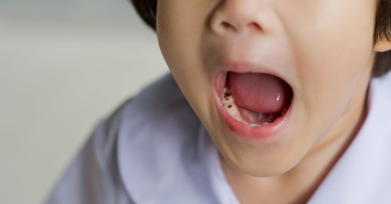 子どもに発生しやすい奥歯の虫歯