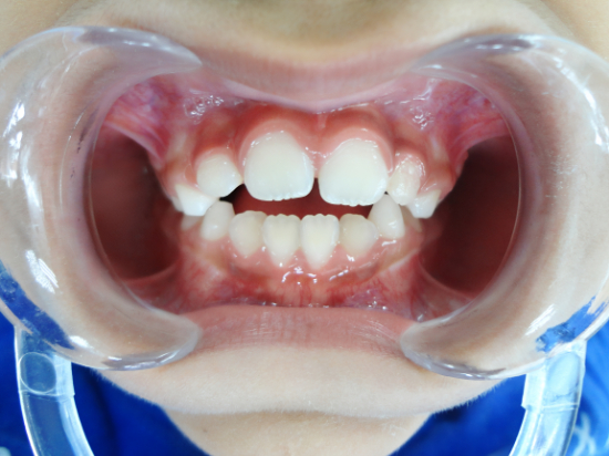 こどもの不正咬合の症例