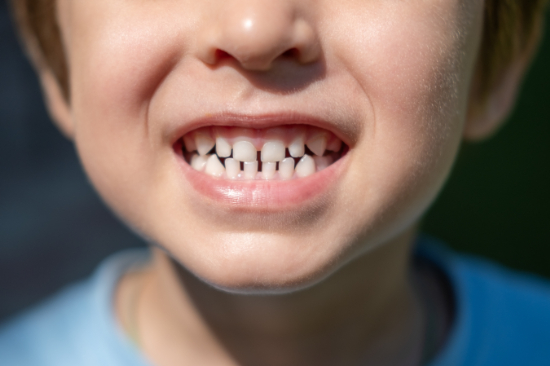 すきっ歯の男の子