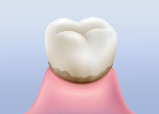 虫歯の原因となる磨き残しのイメージ
