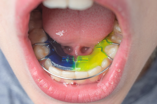 下顎に床矯正の装置を装着している子どもの口内